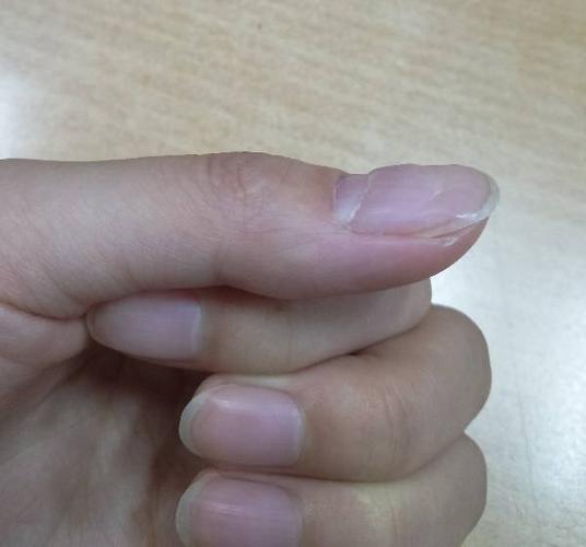 大拇指指甲一截一截的在长是怎么回事?
