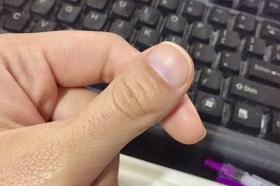 大拇指指甲盖又宽又短弯曲90代表什么优质
