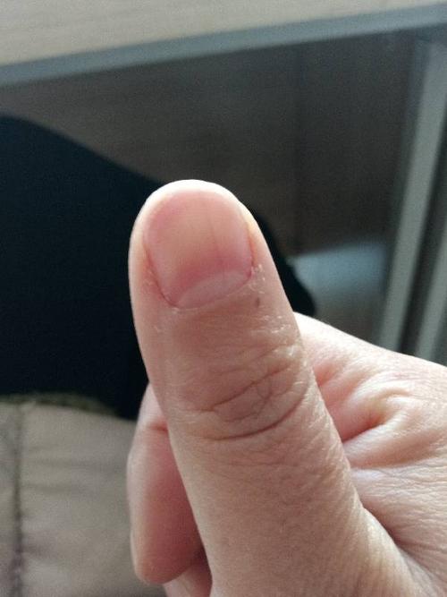 大拇指指甲有综色竖纹是怎么回事?
